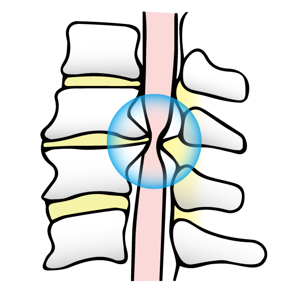 脊椎管狭窄症